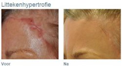 Hoe is Staudt Litteken creme ontstaan